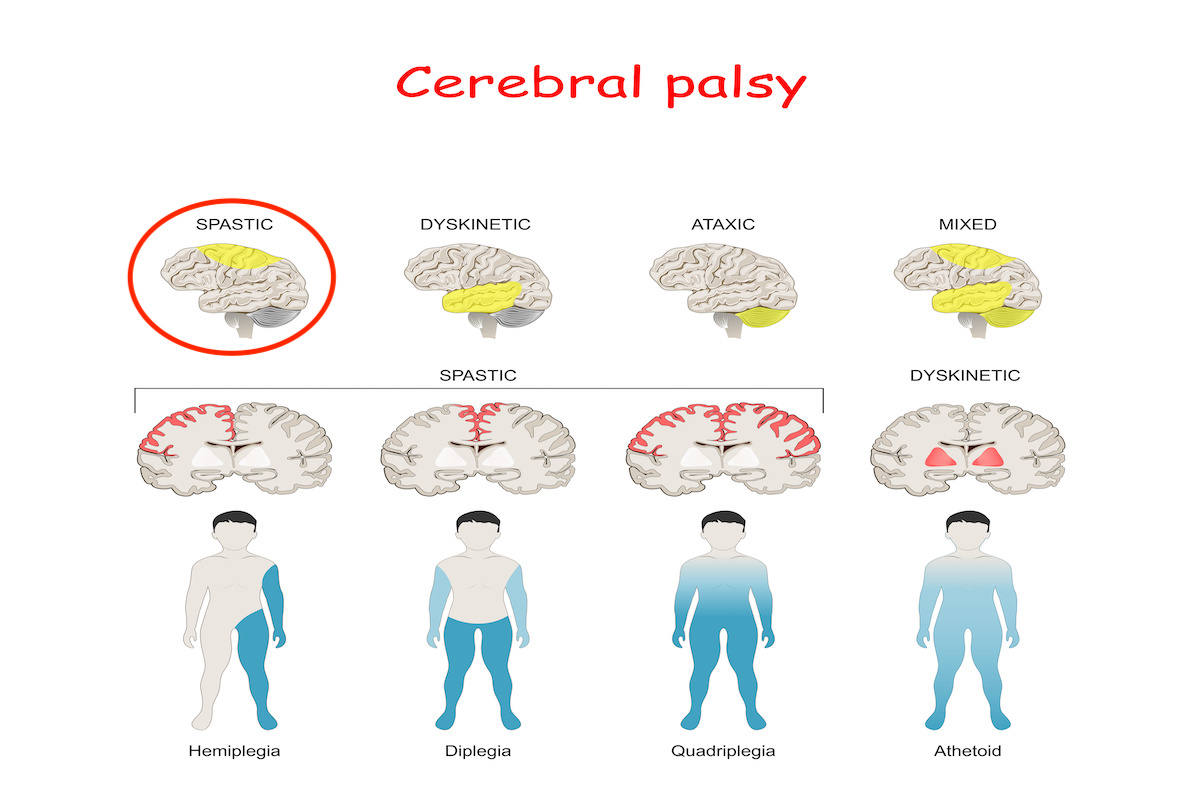 Jenis-jenis gangguan cerebral palsy