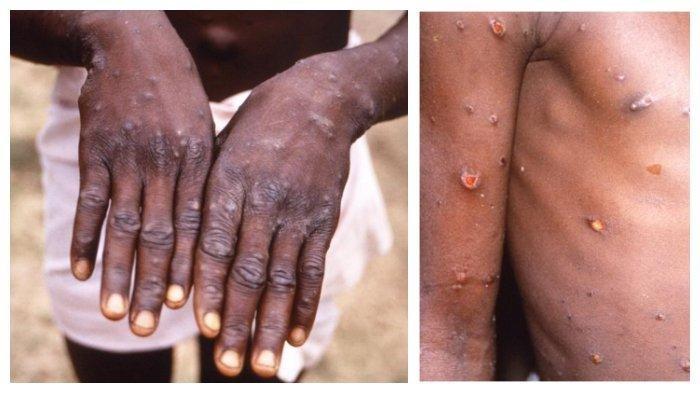 Virus monkeypox penyakit cacar monyet yang pertama kali muncul di Singapura