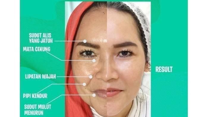 Foto before after Umi Kalsum ibunda Ayu Ting Ting setelah botox hingga tanam benang