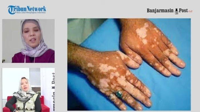 Vitiligo si Putih bukan Panu, dibahas dalam tayangan BTalk bersama Spesialis Kulit Kelamin RSUD Ansari Saleh Banjarmasin, dr Dwiana Savitri SpKK FINSDV FAADV, dipandu Anjar Wulandari, jurnalis Banjarmasin Post, Selasa (27/7/2021).