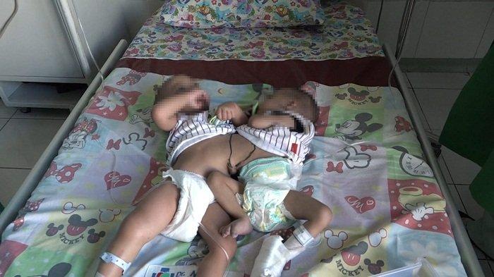 Bayi kembar siam Ba dan Br yang berhasil dipisahkan oleh tim dokter RSUD Dr Moewardi Solo, Rabu (21/4/2021).