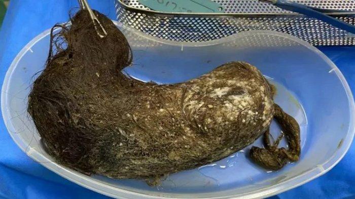 Bola rambut yang terdapat di perut remaja yang mengidap sindrom rapunzel