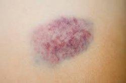Sering Disebut Memar, Kenali Jenis dan Gejala Hematoma, Paling Bahaya di Sekitar Kepala