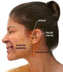 Jangan Sepelekan Kedutan di Wajah Bisa Potensi Hemifacial Spasm, Apa Itu Hemifacial Spasm ?