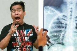 Bopak Castello Hidup dengan Satu Paru-paru, Rutin Minum Ramuan Alami Ini Rahasianya Bertahan Hidup!
