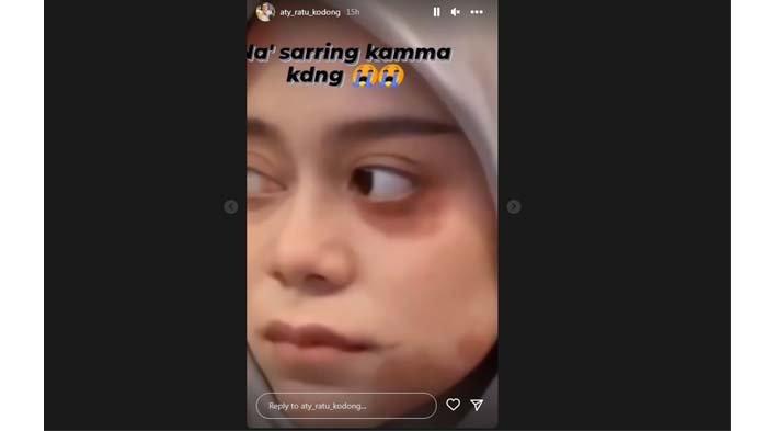 Aty Kodong mengunggah foto wajah Lesty lebam-lebam. Ternyata ini fakta sebenarnya