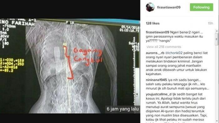 Beredar foto rotgen Eno Farihah 18, yang dibunuh secara sadis oleh tiga pemuda di messnya, Jatimulya, Dadap, Kosambi, Kabupaten Tangerang.