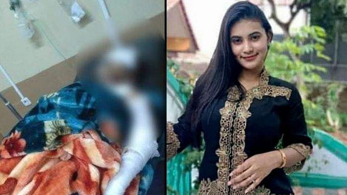 Seorang suami AL (29) di Cianjur tega menyiramkan air keras kepada istrinya, Sarah (21) hingga mengalami luka bakar serius, Sabtu (20/11/2021)