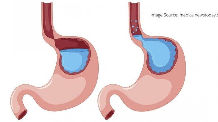 ilustrasi lambung sehat dan lambung yang mengalami peningkatan asam, simak ulasan dr. Nadia Alaydrus