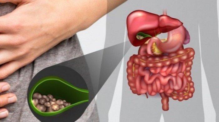 ilustrasi batu empedu, simak penuturan Dokter Spesialis Penyakit Dalam Konsultan Gastroentero-Hepatologi, dr. Hasan Maulahela