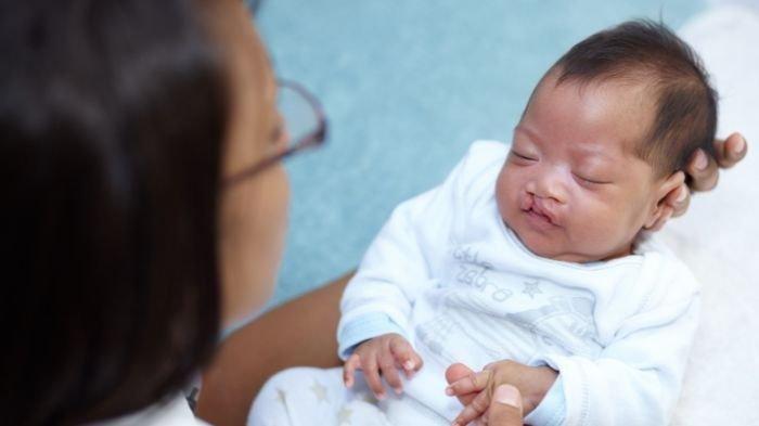 Seoranh bayi yang mengalami bibir sumbing