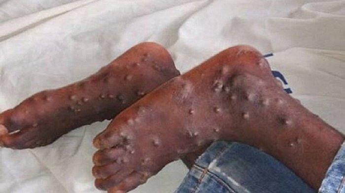 Ilustrasi cacar monyet atau monkeypox yang muncul di bagian kaki