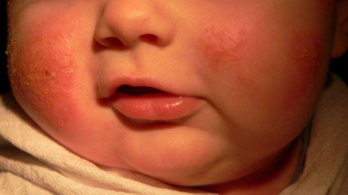 ilustrasi dermatitis atopik