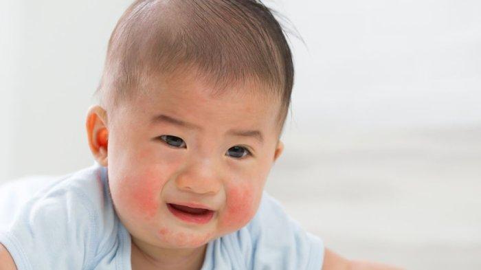 ilustrasi bayi yang mengalami dermatitis atopik