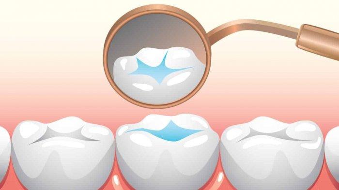 ilustrasi fissure sealant