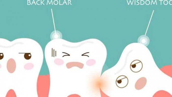 ilustrasi gigi impaksi, Dokter Gigi, Dr. drg. Munawir H. Usman, SKG., MAP terangkan tindakan yang bisa dilakukan
