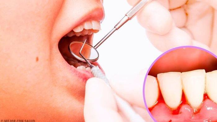 ilustrasi gingivitis atau radang gusi