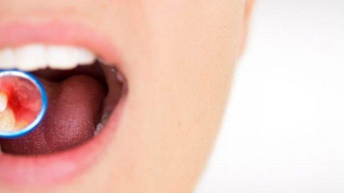 ilustrasi gingivitis