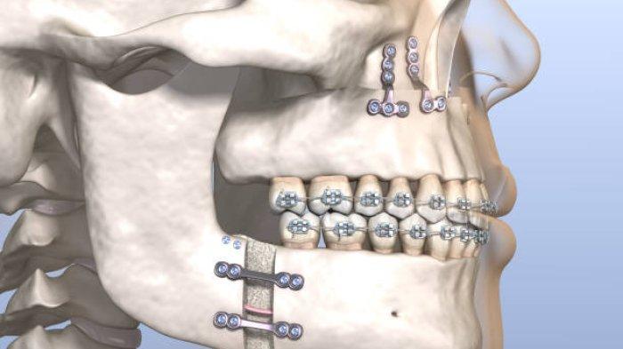 Ilustrasi bedah rahang, begini kata Dokter Gigi Spesialis Orthodonsia, drg. Ardiansyah S. Pawinru, Sp. Ort (K)