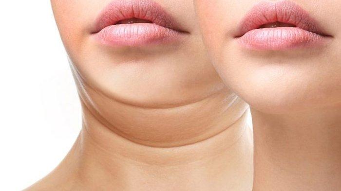 Ilustrasi double chin yang seringkali membuat insecure, begini penjelasan dr. Caryn Miranda Saptari