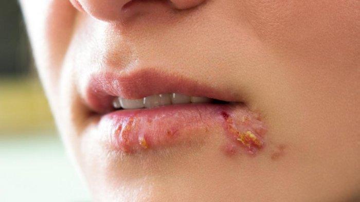 Ilustrasi Herpes labialis