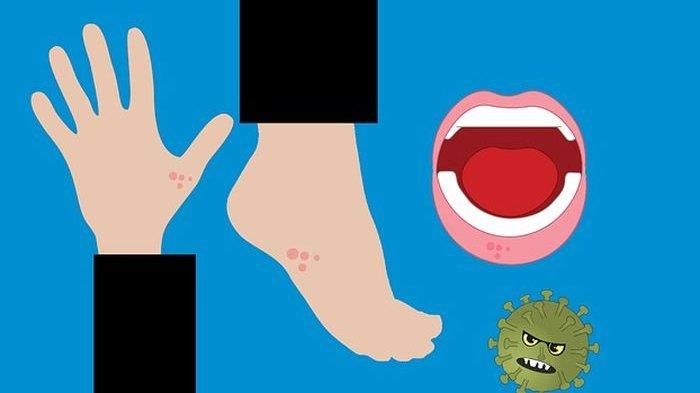 Ilustrasi komplikasi akibat flu Singapura