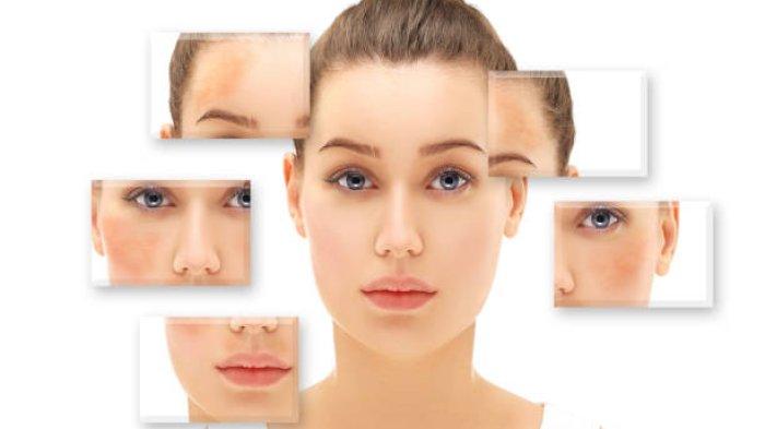 Ilustrasi munculnya melasma pada wajah, simak penjelasan Dokter Kecantikan, dr. Tata mengenai penyebab munculnya melasma