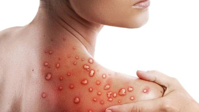 Ilustrasi penderita monkeypox atau cacar monyet