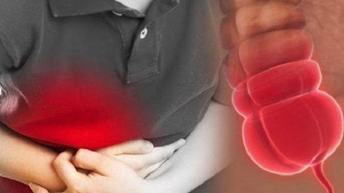 Ilustrasi penderita usus buntu, dokter sarankan untuk segera periksa ke dokter