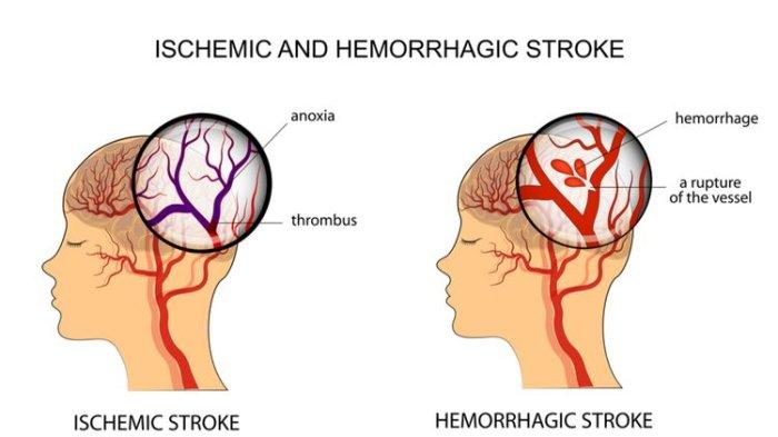 Ilustrasi stroke iskemik dan stroke