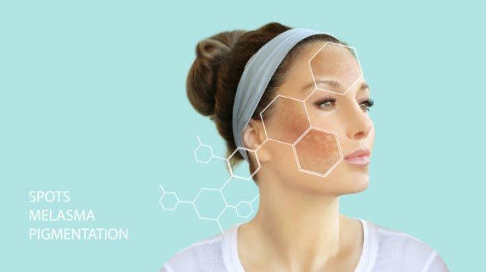 Ilustrasi munculnya melasma pada wajah, simak penjelasan Dokter Kecantikan, dr. Tata mengenai penyebab munculnya melasma