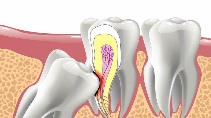 Ilustrasi terjadinya impaksi gigi