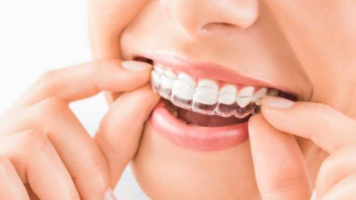 ilustrasi invisalign, simak pemaparan drg. R. Ngt. Anastasia Ririen Pramudyawati