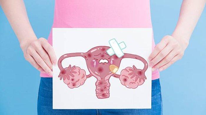 Ilustrasi kanker serviks