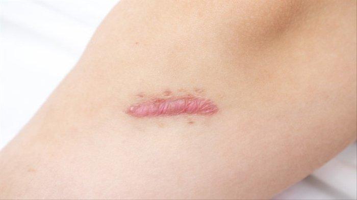 Ilustrasi bekas luka yang menjadi keloid