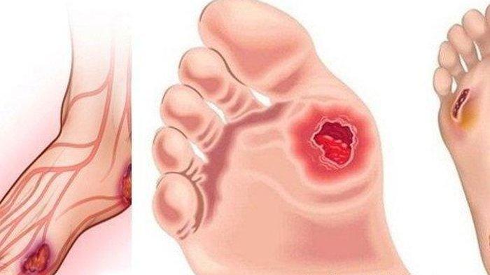 Ilustrasi luka pada kaki