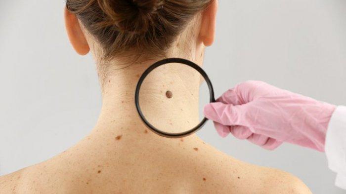 ilustrasi skin tag yang dapat berpotensi menjadi kanker kulit, simak penjelasan dr. Indra Teguh Wiryo, Sp.KK
