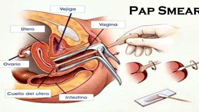 ilustrasi pemeriksaan pap smear