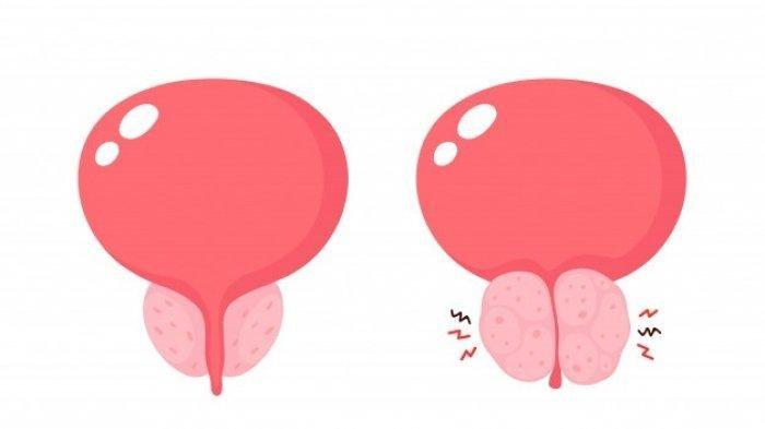 ilustrasi pembesaran prostat