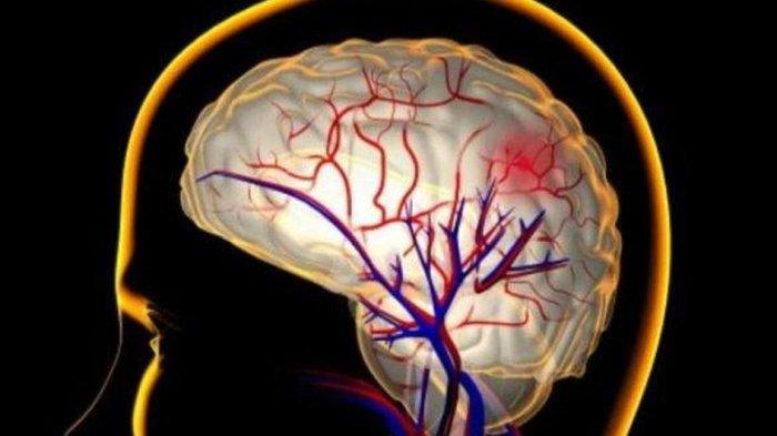 Ilustrasi tumor otak