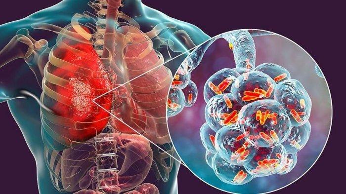 Ilustrasi paru-paru yang mengalami pneumonia
