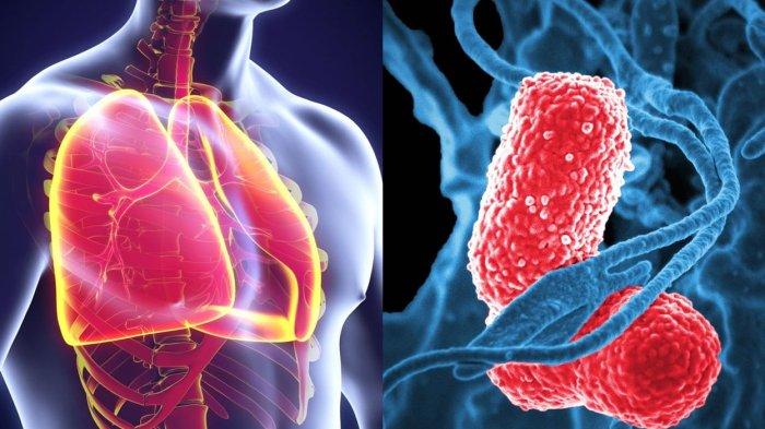 ilustrasi penyakit pneumonia, begini ulasan Dokter Spesialis Konsultan Paru, dr. Hendrastutik Apriningsih, Sp.P, (K), M.Kes