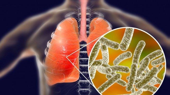 ilustrasi paru-paru penderita pneumonia