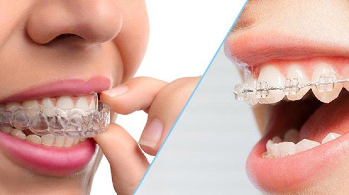ilustrasi perbedaan penggunaan behel dan clean aligner