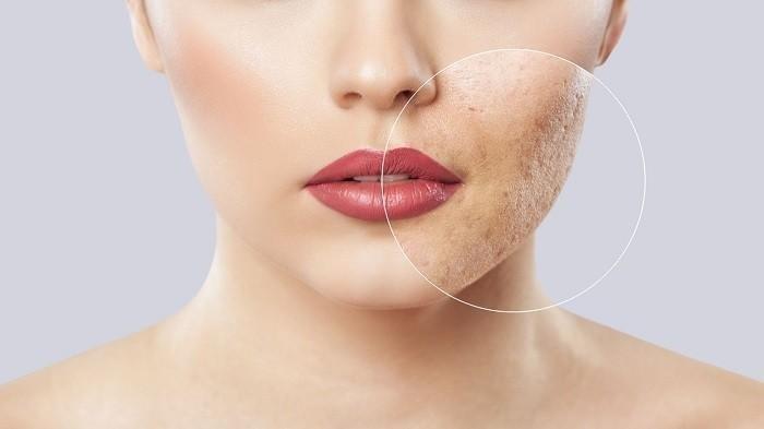Ilustrasi skin barrier yang rusak