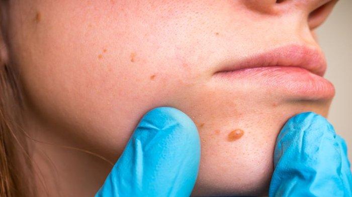Ilustrasi seseorang yang memiliki skin tag, simak penjelasan dr. Indra Teguh Wiryo, Sp.KK