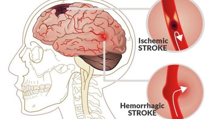 ilustrasi penyebab penyakit stroke