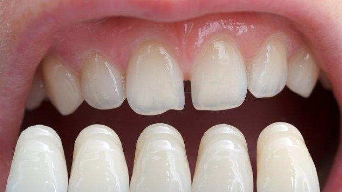 Ilustrasi veneer gigi