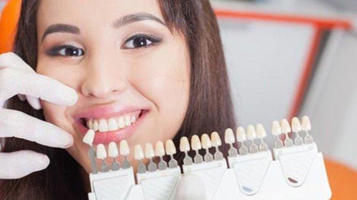 Ilustrasi veneer gigi