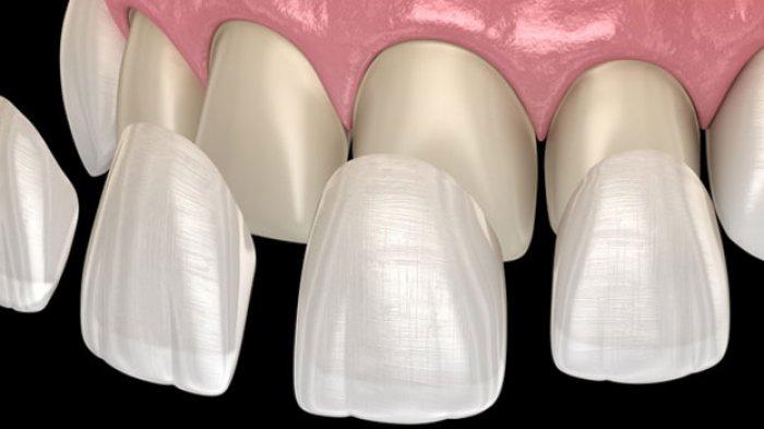 ilustrasi veneer gigi